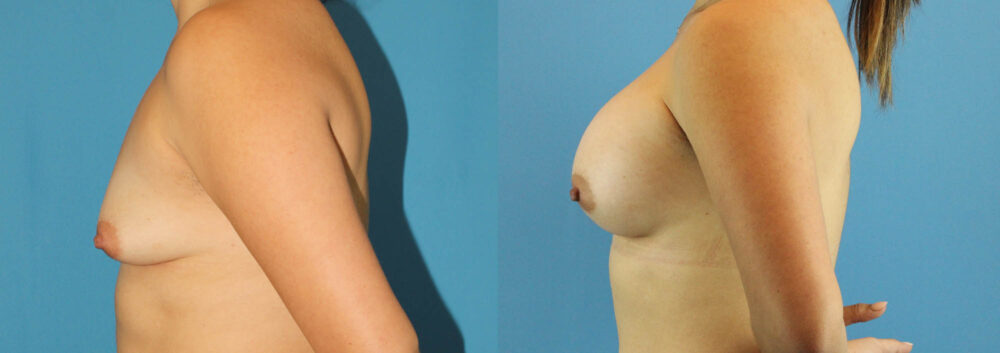 Breast Augmentation case #6262
