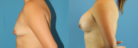 Breast Augmentation case #6262