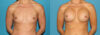 Breast Augmentation case #6273 slider thumbnail