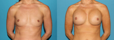 Breast Augmentation case #6273