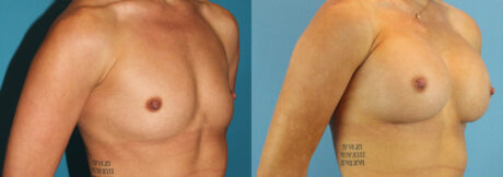 Breast Augmentation case #6273