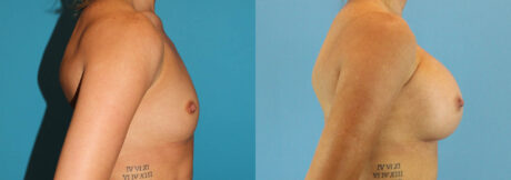 Breast Augmentation case #6273