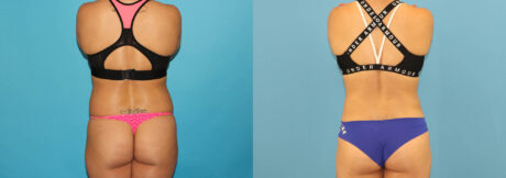 Liposuction case #6009