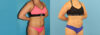 Liposuction case #6009 slider thumbnail