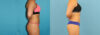 Liposuction case #6009 slider thumbnail