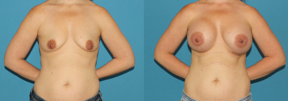 Breast Augmentation case #6268