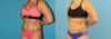 Liposuction case #6009 slider thumbnail