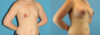 Breast Augmentation case #6268 slider thumbnail