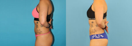 Liposuction case #6009
