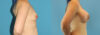 Breast Augmentation case #6268 slider thumbnail