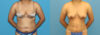 Liposuction case #6011 slider thumbnail