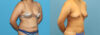 Liposuction case #6011 slider thumbnail