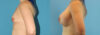 Breast Augmentation case #6268 slider thumbnail