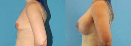 Breast Augmentation case #6268