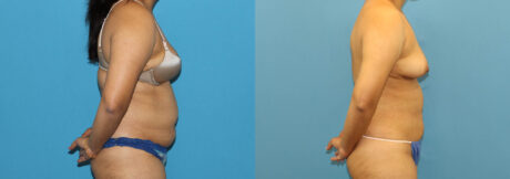 Liposuction case #6011