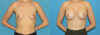 Breast Augmentation case #6279 slider thumbnail