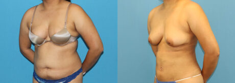 Liposuction case #6011