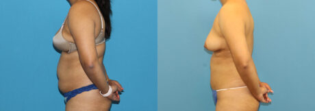 Liposuction case #6011