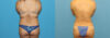 Liposuction case #6011 slider thumbnail