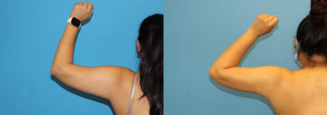 Liposuction case #6011