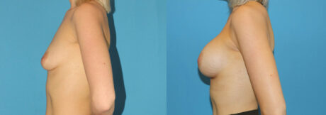 Breast Augmentation case #6279