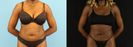 Liposuction case #6012