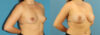 Breast Augmentation case #6285 slider thumbnail