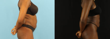 Liposuction case #6012