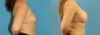 Breast Augmentation case #6285 slider thumbnail