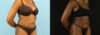 Liposuction case #6012 slider thumbnail