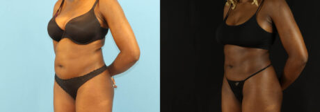 Liposuction case #6012