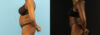 Liposuction case #6012 slider thumbnail