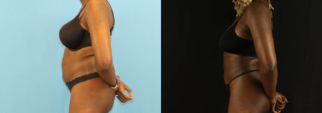 Liposuction case #6012