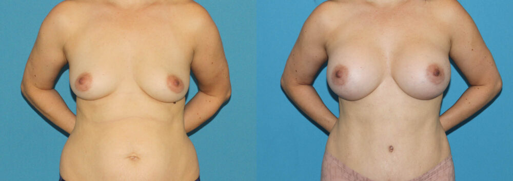 Breast Augmentation case #6291