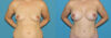 Breast Augmentation case #6291 slider thumbnail