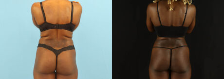 Liposuction case #6012