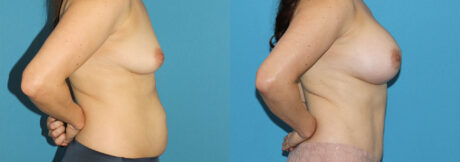 Breast Augmentation case #6291