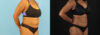 Liposuction case #6013 slider thumbnail