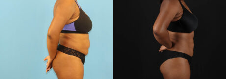 Liposuction case #6013