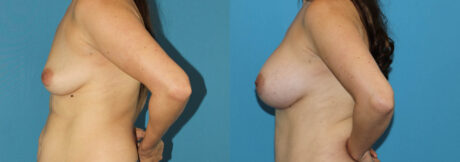 Breast Augmentation case #6291