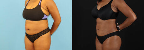 Liposuction case #6013