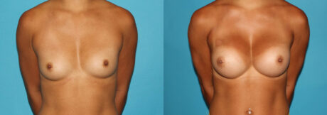 Breast Augmentation case #5997
