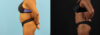 Liposuction case #6013 slider thumbnail