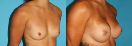 Breast Augmentation case #5997