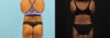 Liposuction case #6013 slider thumbnail