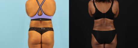 Liposuction case #6013