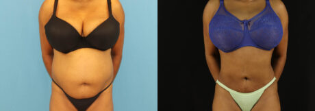 Liposuction case #6014