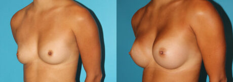 Breast Augmentation case #5997