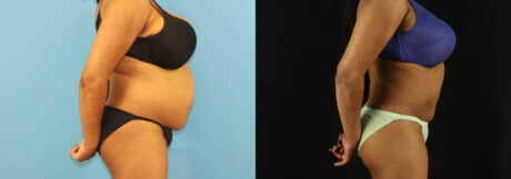Liposuction case #6014