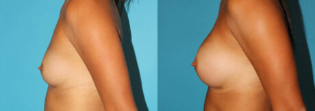 Breast Augmentation case #5997